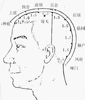 囪會穴|針灸學/囟會穴